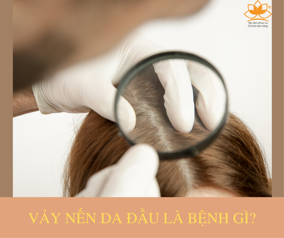 VẢY NẾN DA ĐẦU LÀ BỆNH GÌ?